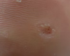 Verruca treatment Bedford