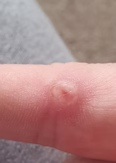 Wart removal treatment Bedford