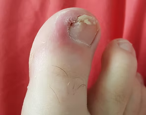 Ingrown toenail treatment Bedford